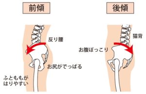 骨盤の前傾、後傾のイメージ画像