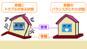 骨盤の歪みを家に例えたときのイメージ画像
