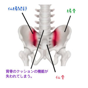 仙腸関節の固まりが腰痛を引き起こす原因となることのイメージ画像