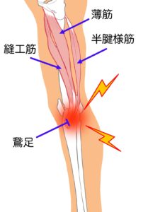 鵞足とは薄筋、半腱様筋、縫工筋の停止部のこと