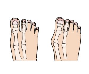 正常な足と外反母趾を比較した画像
