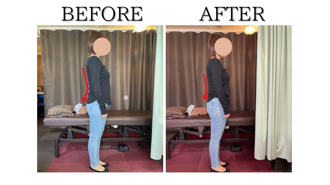 3回の整体で反り腰改善がみられた方の3回の整体で反り腰改善がみられた方の画像