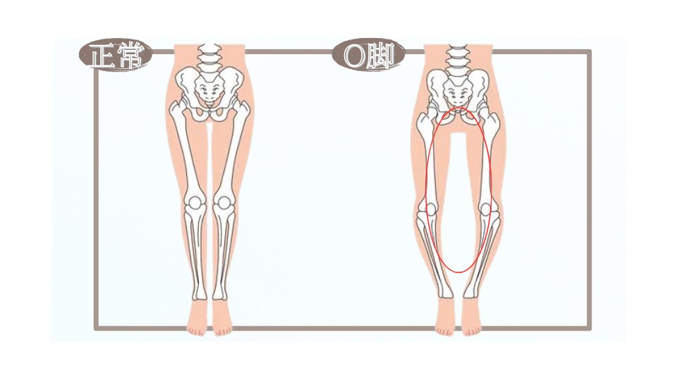 正常な脚とO脚の比較画像