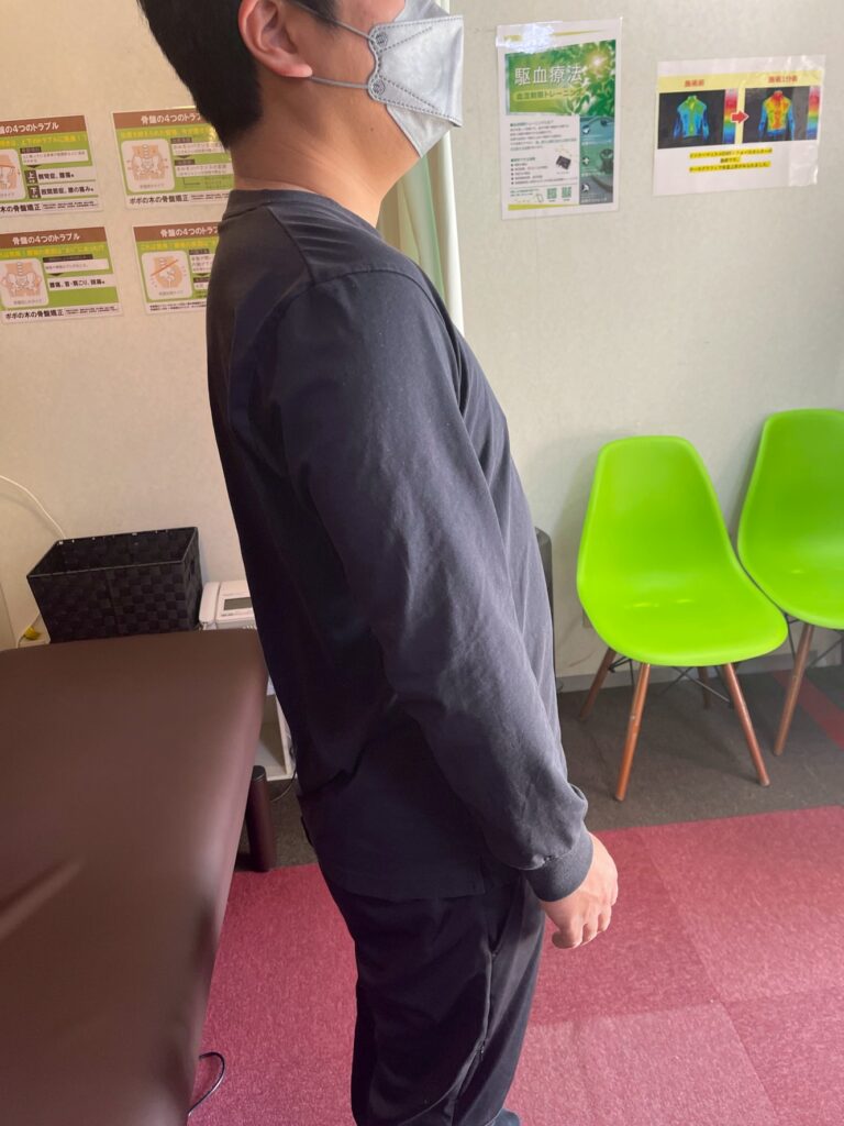 骨盤が出やすく腰が反りやすい立ち方　イメージ画像