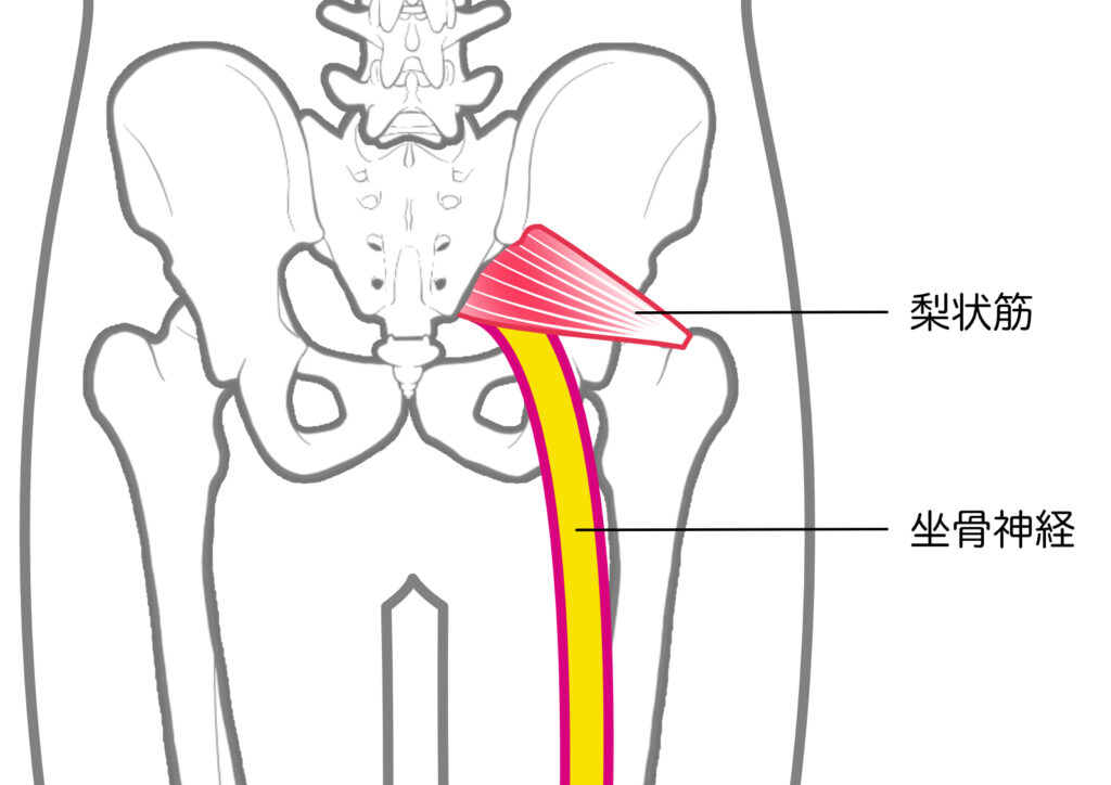 坐骨神経痛