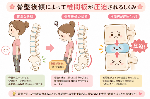 骨盤バランスと姿勢のイメージ図