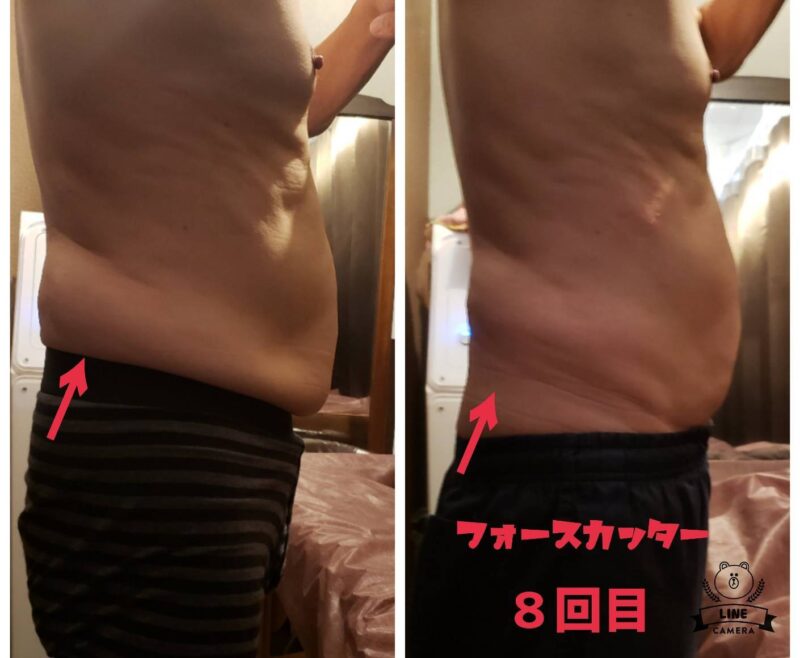 フォースカッター施術のお写真