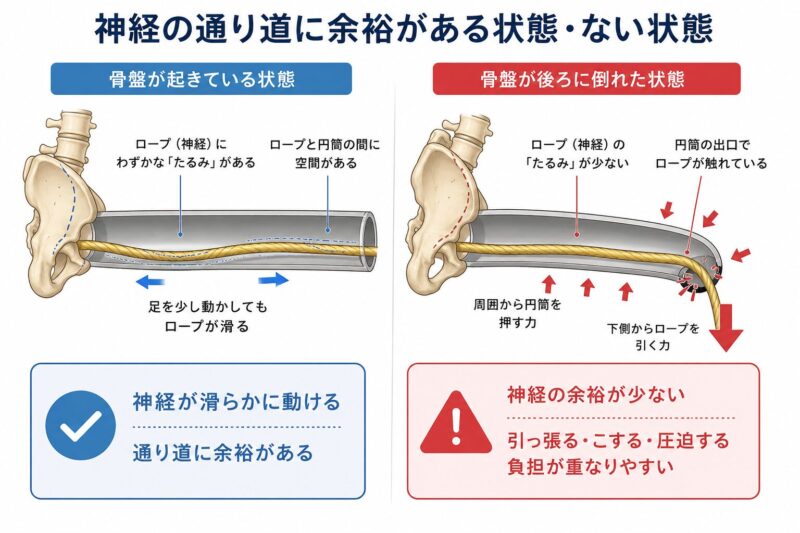 坐骨神経が筒の中を通っている様子と、骨盤が倒れて筒が狭くなる説明図