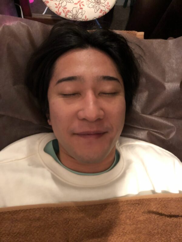 小顔矯正の施術後
