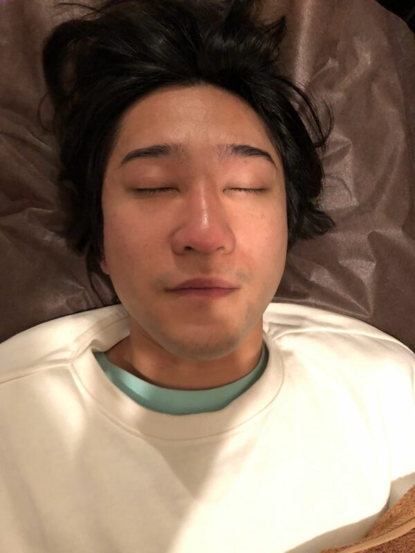 小顔矯正の施術前